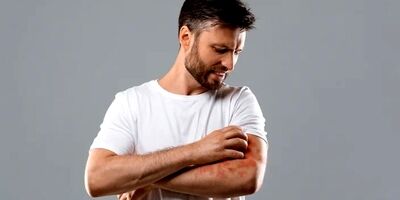 کهیر عصبی چیست ؟ علائم و راهکارهایی برای درمان کهیر عصبی