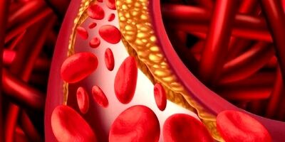 چند توصیه برای کاهش چربی خون
