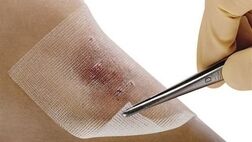روش‌های پیشگیری از بیماری سیاه زخم چیست؟