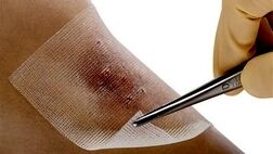 روش‌های پیشگیری از بیماری سیاه زخم چیست؟