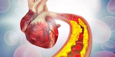 علائم نارسایی قلبی کدامند؟
