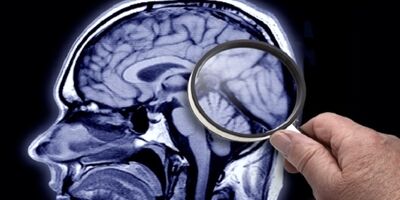 نشانگرهای خونی بیماری آلزایمر را از ۱۰ سال قبل نشان می دهند