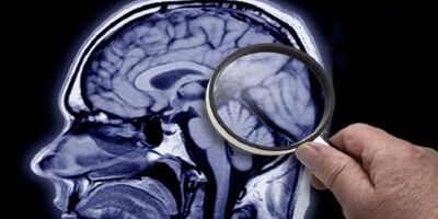 نشانگرهای خونی بیماری آلزایمر را از ۱۰ سال قبل نشان می دهند