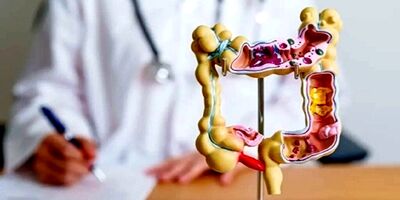 استرس مزمن و تأثیر آن بر پیشرفت سرطان روده بزرگ
