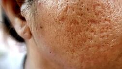 بهترین راهکارهای پزشکی و خانگی برای از بین بردن جای زخم‌
