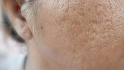 بهترین راهکارهای پزشکی و خانگی برای از بین بردن جای زخم‌