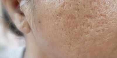 بهترین راهکارهای پزشکی و خانگی برای از بین بردن جای زخم‌
