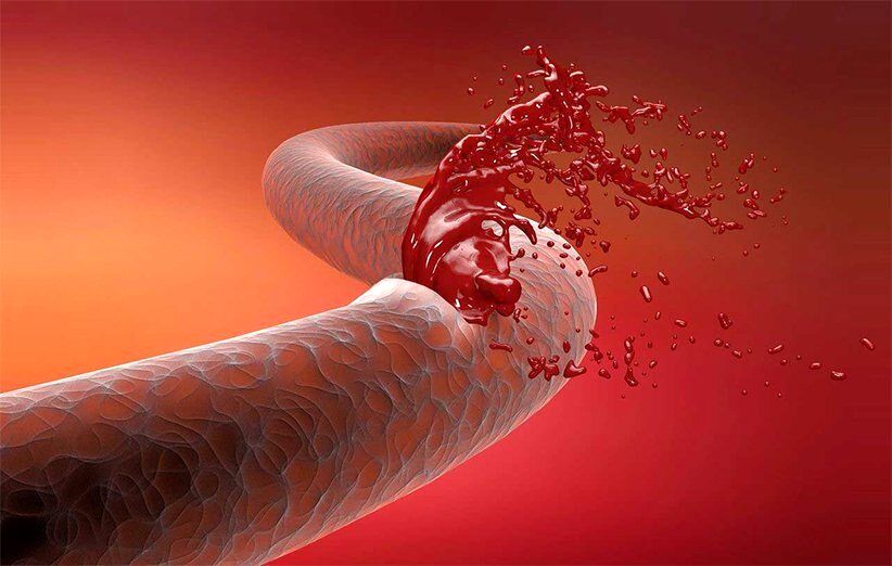 راههای بند آوردن خونریزی شدید