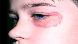 افراد دارای بیماری‌ های زمینه‌ ای به قارچ سیاه مبتلا می‌ شوند