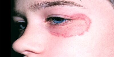 افراد دارای بیماری‌ های زمینه‌ ای به قارچ سیاه مبتلا می‌ شوند