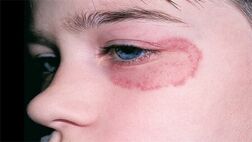 افراد دارای بیماری‌ های زمینه‌ ای به قارچ سیاه مبتلا می‌ شوند