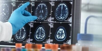 مواد قندی عامل ابتلا به زوال عقل است؟
