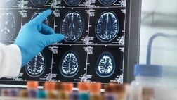 مواد قندی عامل ابتلا به زوال عقل است؟
