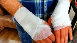 بیمه سلامت هزینه سوختگی را چگونه پوشش می‌دهد
