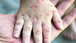 افزایش ۷۹ درصدی موارد ابتلا به سرخک در جهان
