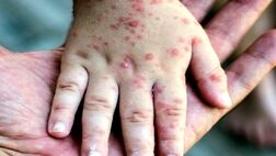 افزایش ۷۹ درصدی موارد ابتلا به سرخک در جهان
