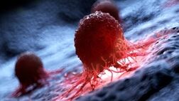 شناسایی زودهنگام سرطان با MRI

