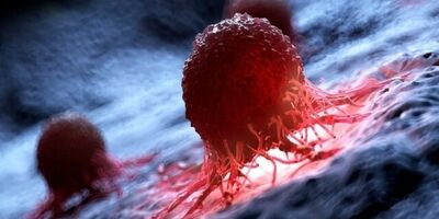 شناسایی زودهنگام سرطان با MRI
