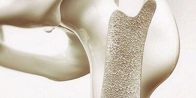 استخوان های ضعیف موجب تضعیف مغز می شود