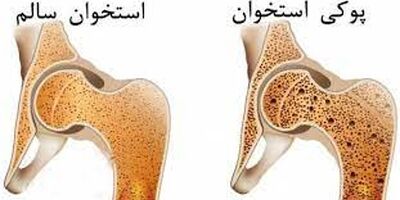 فقط ۲۰ درصد از مبتلایان به پوکی استخوان در جهان درمان می‌شوند