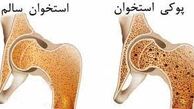 فقط ۲۰ درصد از مبتلایان به پوکی استخوان در جهان درمان می‌شوند