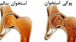فقط ۲۰ درصد از مبتلایان به پوکی استخوان در جهان درمان می‌شوند