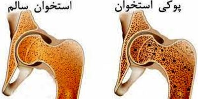 فقط ۲۰ درصد از مبتلایان به پوکی استخوان در جهان درمان می‌شوند