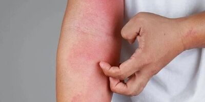 چطور از شر خارش و التهاب پوست در فصل بهار رها شویم؟