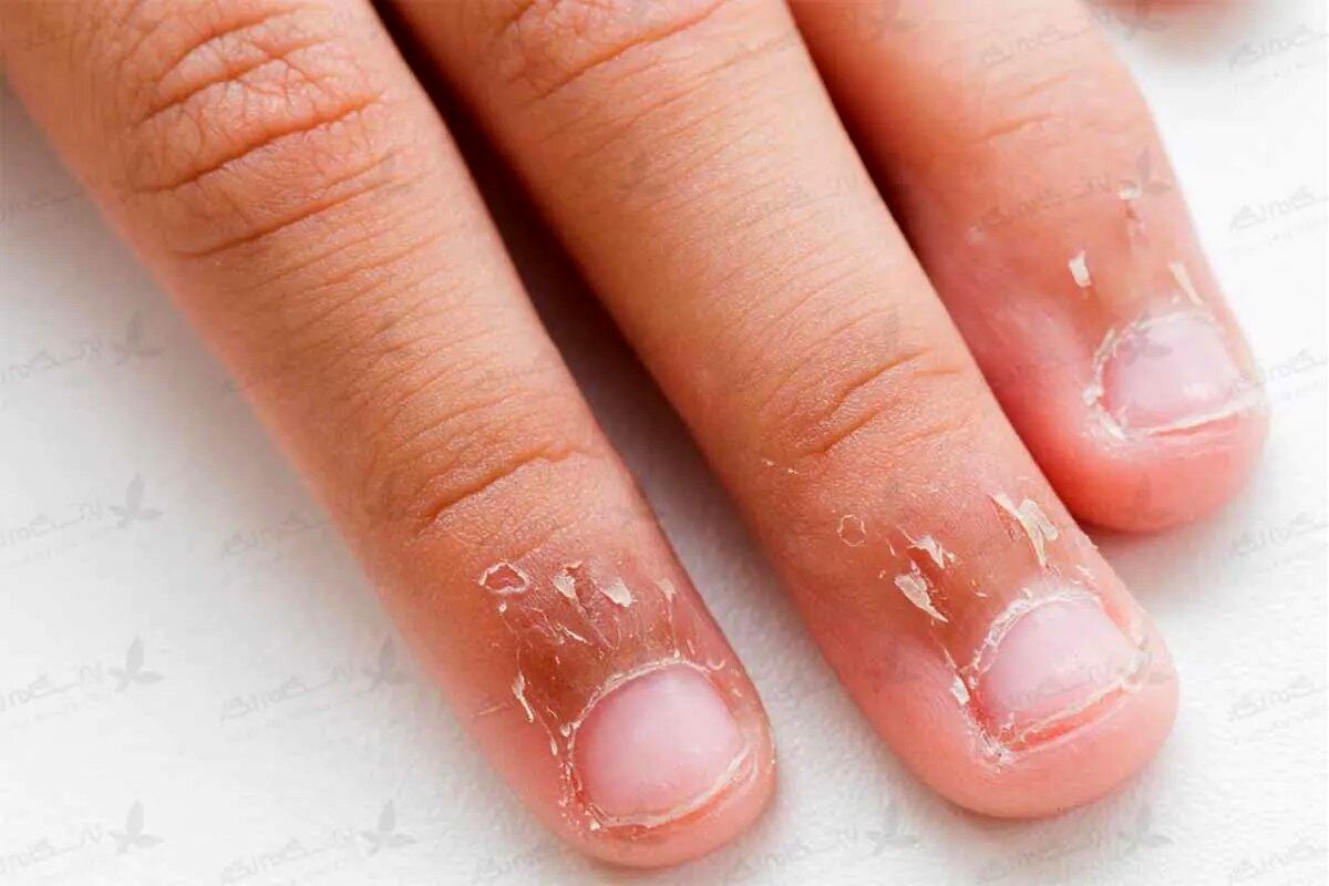 علت پوستپوست شدن اطراف ناخن و روشهای درمان