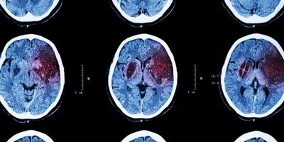 چگونه از سکته مغزی جلوگیری کنیم؟
