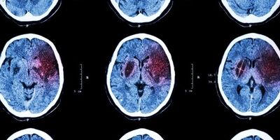 چگونه از سکته مغزی جلوگیری کنیم؟
