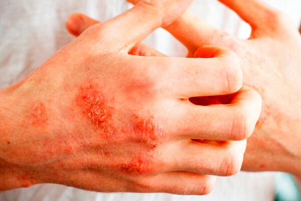 چطور اگزما رو مهار کنیم؟