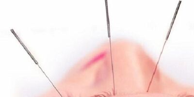 طب سوزنی در کاهش سردردهای تنشی موثر است