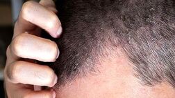 اگزمای پوست سر چیست و چطور درمان می‌شود؟

