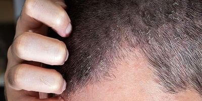با این علائم اگزمای شدید آشنا شوید
