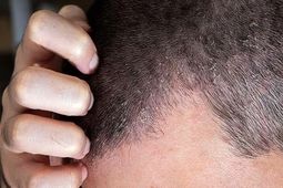اگزمای پوست سر چیست و چطور درمان می‌شود؟
