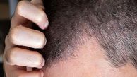 اگزمای پوست سر چیست و چطور درمان می‌شود؟
