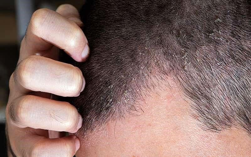 اگزمای پوست سر چیست و چطور درمان میشود؟