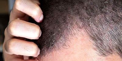 اگزمای پوست سر چیست و چطور درمان می‌شود؟
