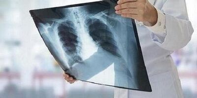 ابتلای بیش از ۷۰۰۰ نفر به سل در ۱۴۰۲ 