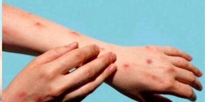 سرعت جهش ژنی «آبله میمونی 1b»