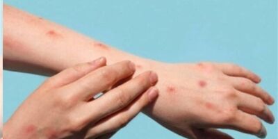 سرعت جهش ژنی «آبله میمونی 1b»