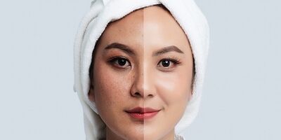 علت تیرگی پوست صورت و راه های درمان آن
