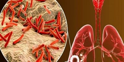 پوشش درمان سل در ایران بیش از ۸۰ درصد است