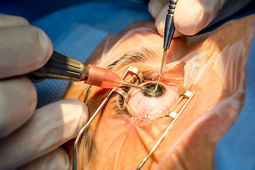 هزینه عمل چشم با بیمه تکمیلی در سال ۱۴۰۴ چقدر است؟