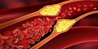 چرا کلسترول در زمستان بالا می‌رود؟
