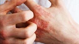 توصیه‌های ضروری برای حساسیت پوستی