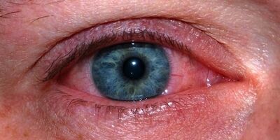 «برف کوری» چیست و چگونه از آن پیشگیری کنیم؟
