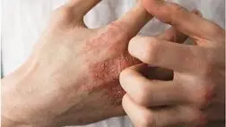 ۶ راهکار برای جلوگیری از خشکی پوست
