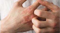 ۶ راهکار برای جلوگیری از خشکی پوست
